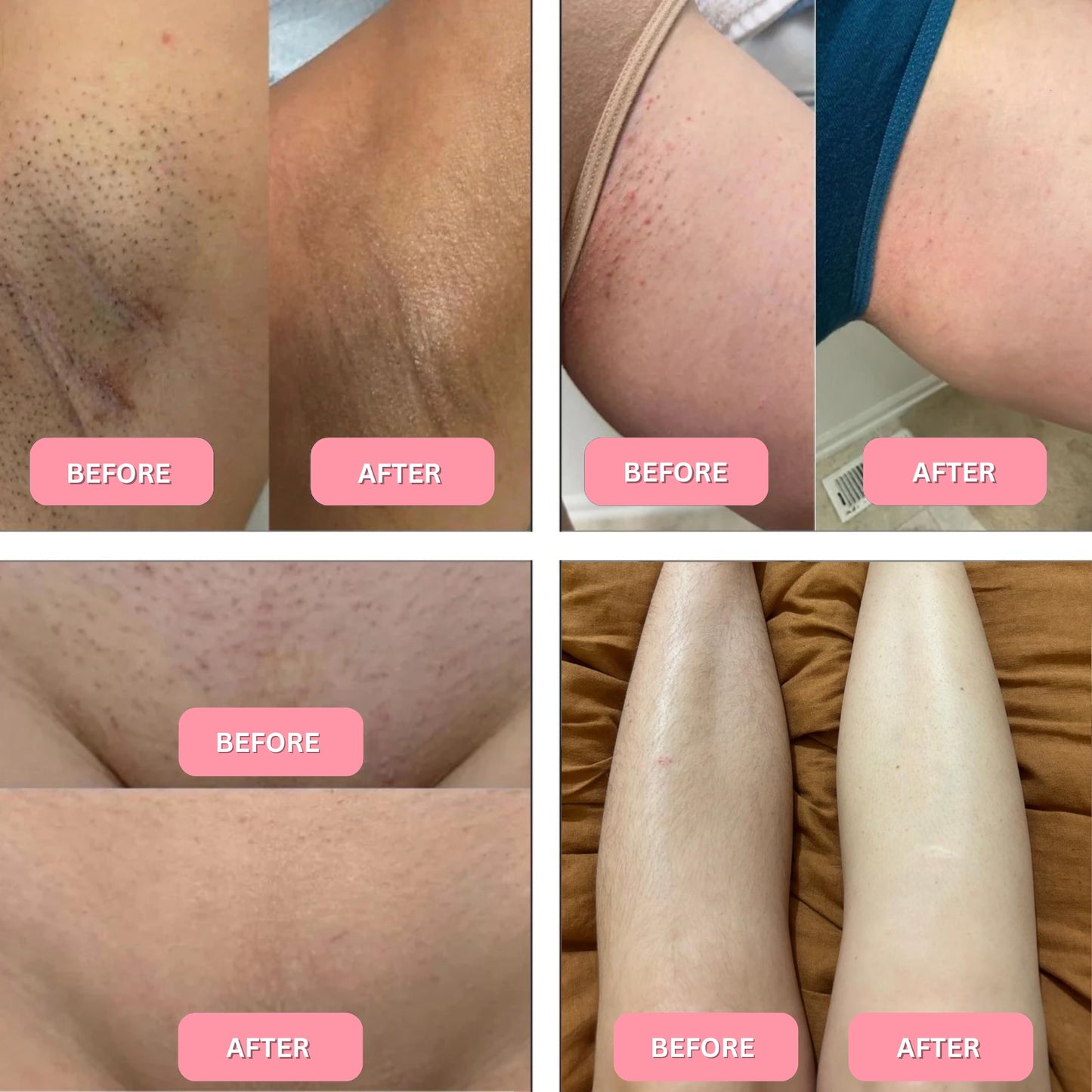 Before and after images showing skin results from π¦πΉπ²π²πΈππΉπΆπ±π² π£πΏπΌ hair removal, demonstrating smoothness and clarity.